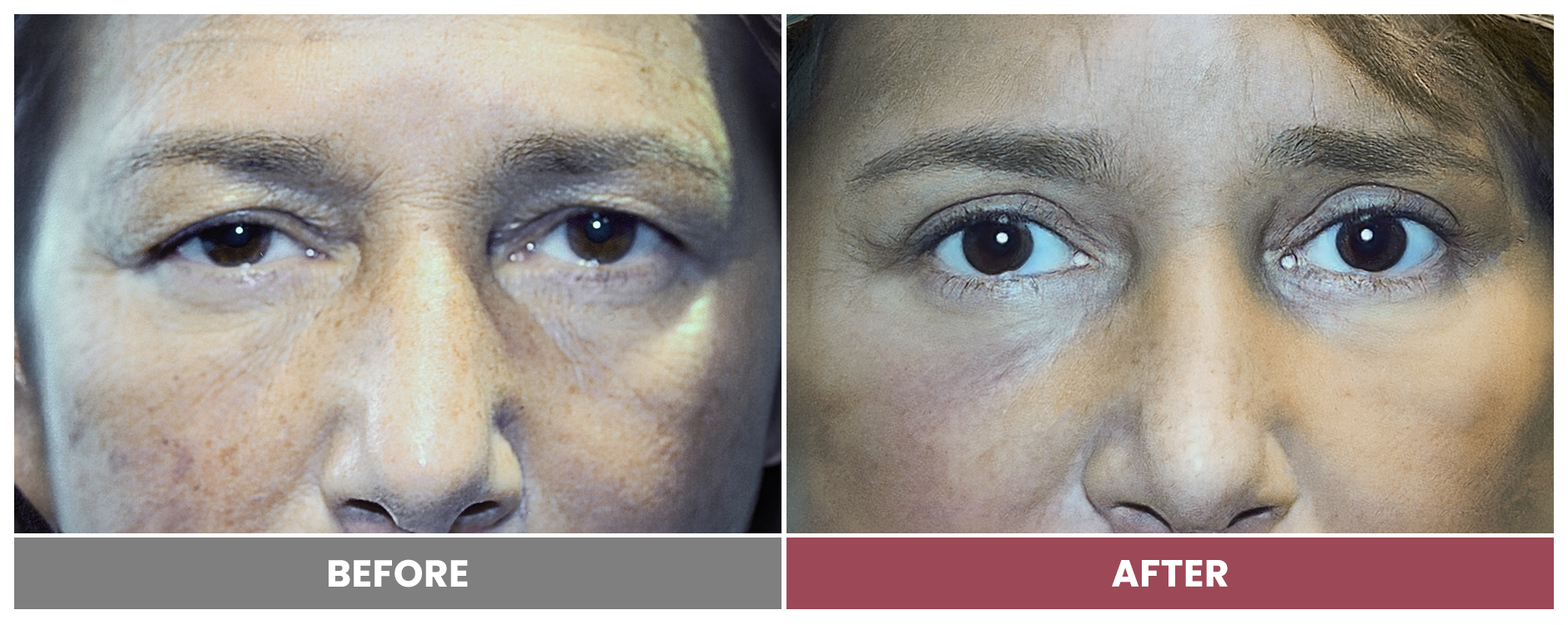 Upper Blepharoplasty - Case 10